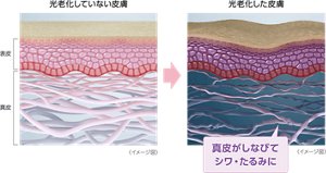 光老化していない皮膚と光老化した皮膚のイメージ図