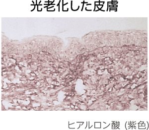 光老化した皮膚