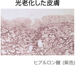 光老化した皮膚
