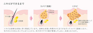 ニキビができるまで ニキビは過剰な皮脂に深く関連しています。過剰な皮脂と角質のかたまりがまざってコメド(面皰)となり、毛穴の入り口をふさいでしまうことから、毛穴内でアクネ菌が繁殖してしまい、炎症となります。