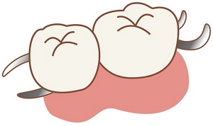 図:部分入れ歯のバネのイラスト