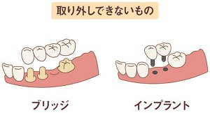 図:取り外しができないもの(ブリッジ、インプラント)のイラスト