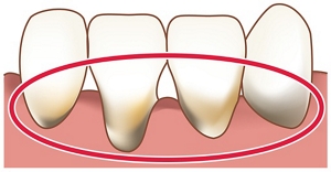 図:歯肉がやせて出てしまった歯根のイラスト