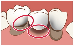 図:歯と歯の間やブリッジのすき間のイラスト