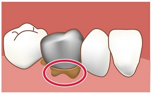 図:治療痕や根元部分のすき間(特に奥歯の周辺)のイラスト