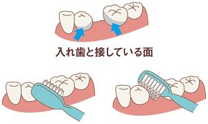 図:部分入れ歯と接している面の磨き方のイラスト