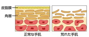 図:肌の皮脂膜と角層のイメージイラスト(正常な肌、荒れた肌)