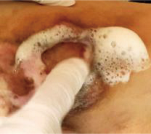 界面活性剤を使用して、創傷部と創周囲の皮膚の洗浄を行っている画像。