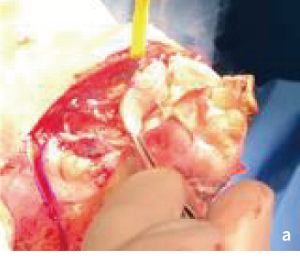 外科的介入、手術室でのデブリードマンの処置画像