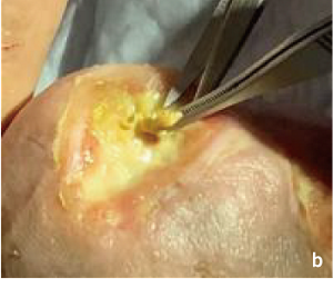 鋭匙による鋭的デブリードマンの処置画像