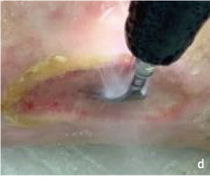 超音波装置によるデブリードマンの処置画像