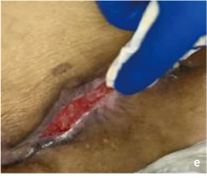 ガーゼを用いた機械的デブリードマンの処置画像