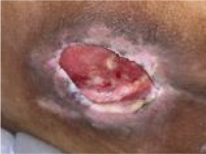 上皮化が進まず、治癒が遅くなっているキズの画像