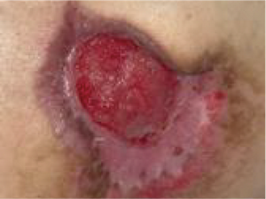 上皮化が進まず、治癒が遅くなっているキズの画像