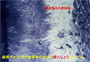歯周ポケット内で細菌等が生体に侵入しようとしている顕微鏡画像。