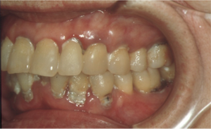 器質的口腔ケアの効果(術前)の写真
