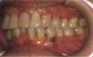 器質的口腔ケアの効果(3か月後)の写真