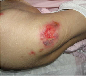 床で転倒し数時間が経過 した写真