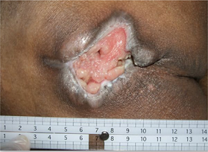 臨界的定着疑い(I3C)の写真