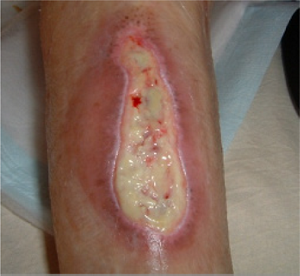 自己融解が進んでいる壊死組織の写真