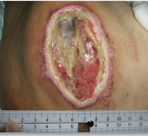 遊離した壊死組織の写真