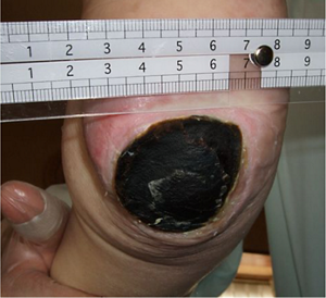 壊死組織N6(硬く厚い壊死組織)の写真