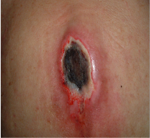 壊死組織N6(硬く厚い壊死組織)の写真