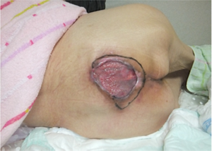 在宅療養者Aさんの症例写真