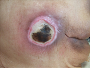 在宅療養者Bさんの症例写真