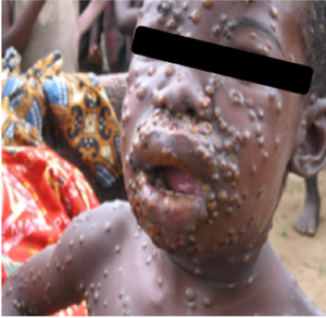 コンゴ民主共和国の子供のサル痘患者の写真