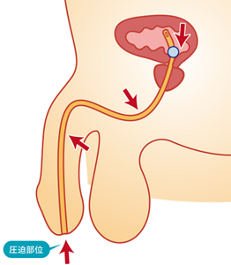 尿道留置カテーテルの場合のカテーテルの挿入部位を表したイラスト