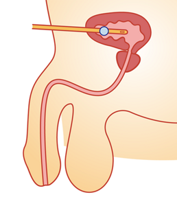 膀胱瘻の場合のカテーテルの挿入部位を表したイラスト