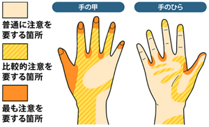 手洗いミスの発生箇所のイラスト。普通に注意を要する箇所:手の甲側は中央部、手のひら側は小指と薬指の延長線上と各指の中央部、比較的注意を要する箇所:手の甲側は各指の中央部と手首付近、手のひら側は指先と親指の付け根付近、最も注意を要する箇所:手の甲側は指先と親指の付け根と指の間、手のひら側は指の間