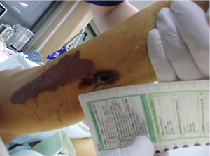 急性重症状態(急性心筋梗塞心肺停止蘇生後)の右腓腹部の写真。皮膚に褥瘡が発生している状態。