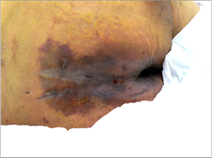 がん終末期(肝細胞がん)仙骨部周囲の写真。がんの進行により仙骨部周囲の褥瘡が悪化している状態。