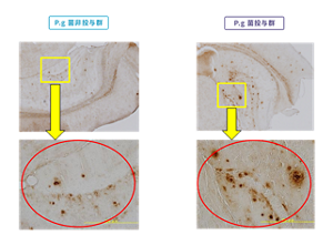 歯周病菌を投与したマウス脳で老人斑が増加していることを示す写真。歯周病菌感染がアルツハイマー病様病変を誘発することを示唆している。