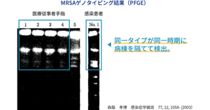 医療従事者の手指を介した感染例の画像。MRSAゲノタイピング結果(PFGE)。医療従事者手指と感染患者で同一タイプが同一次期に病棟を隔てて検出されたことを表す。
