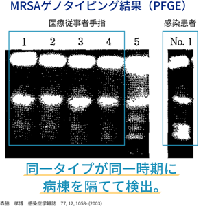 医療従事者の手指を介した感染例の画像。MRSAゲノタイピング結果(PFGE)。医療従事者手指と感染患者で同一タイプが同一次期に病棟を隔てて検出されたことを表す。