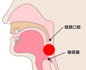 飲食物が喉の奥の下部に詰まり、喉頭蓋を押し付け、気管を塞いでしまうことを表した図。