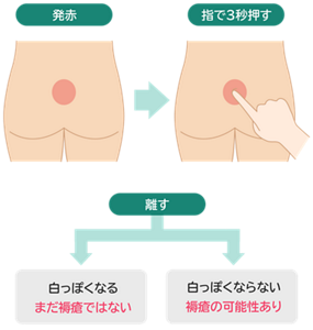 褥瘡の見極め方の図。