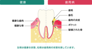 歯が健康な状態と歯周病の状態を表した図。