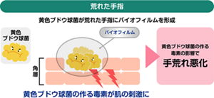 荒れた手指の状態を表すイラスト。黄色ブドウ球菌がバイオフィルムを形成し、黄色ブドウ球菌の作る毒素が肌の刺激になり、その毒素の影響で手荒れが悪化している。