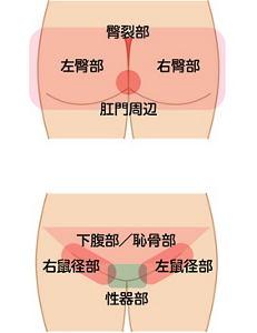 IADの好発部位を表した図。