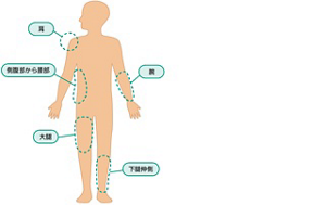 老人性乾皮症の好発部位を表すイラスト。人の身体の「下腿伸側」、「側腹部から腰部」、「肩」、「大腿」、「腕」を示している。