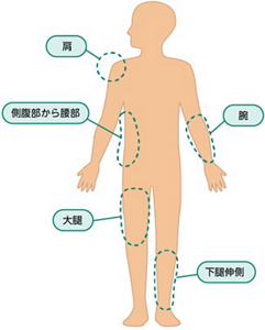 老人性乾皮症の好発部位を表すイラスト。人の身体の「下腿伸側」、「側腹部から腰部」、「肩」、「大腿」、「腕」を示している。