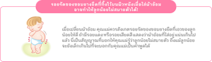 รอยรัดของขอบยางยืดที่ทิ้งไว้บนผิวหนังเมื่อใส่ผ้าอ้อมอาจทำให้ลูกน้อยไม่สบายตัวได้!