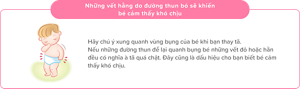 Những vết hằn để lại do những đường thun bó sẽ khiến bé cảm thấy khó chịu
