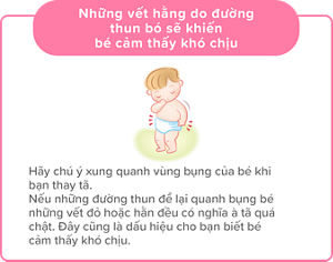 Những vết hằn để lại do những đường thun bó sẽ khiến bé cảm thấy khó chịu