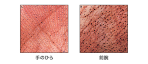 手のひらと手の甲の比較写真。手のひらは黒い点が少なく、手の甲は黒い点が多い