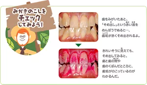 みがきのこしをチェックしてみよう!:歯をみがいたあと、「そめ出し」という赤い液をめんぼうでぬると…、歯垢が赤くそめ出されるよ。きれいそうに見えても、そめ出してみると、歯と歯の間や歯のくぼんだところに、歯垢がのこっているのがわかるんだ。